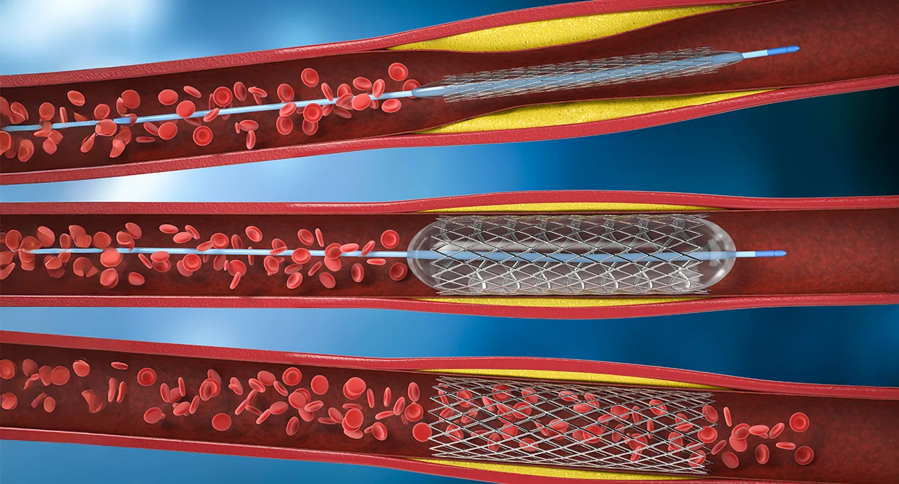 Angioplasty & Stenting
