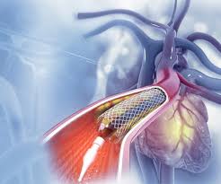 Cardiac Catheterization