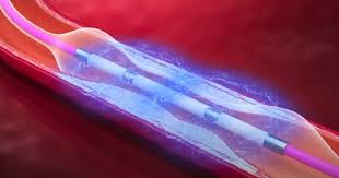 Intravascular Lithotripsy (IVL)