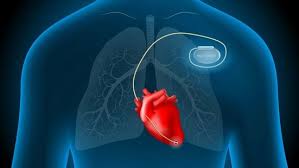 Pacemaker & ICD Management