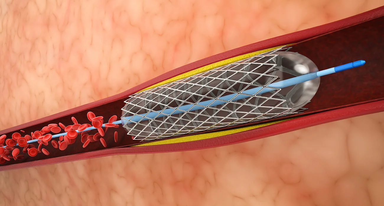 Peripheral Stenting