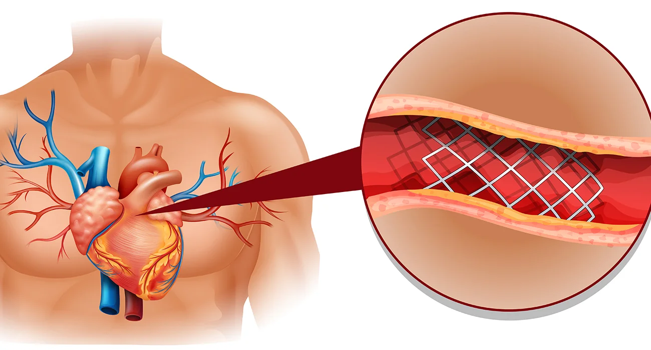 Primary Angioplasty